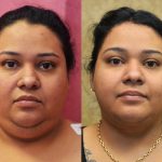Neck & Face Liposuction Before & After Patient #12512