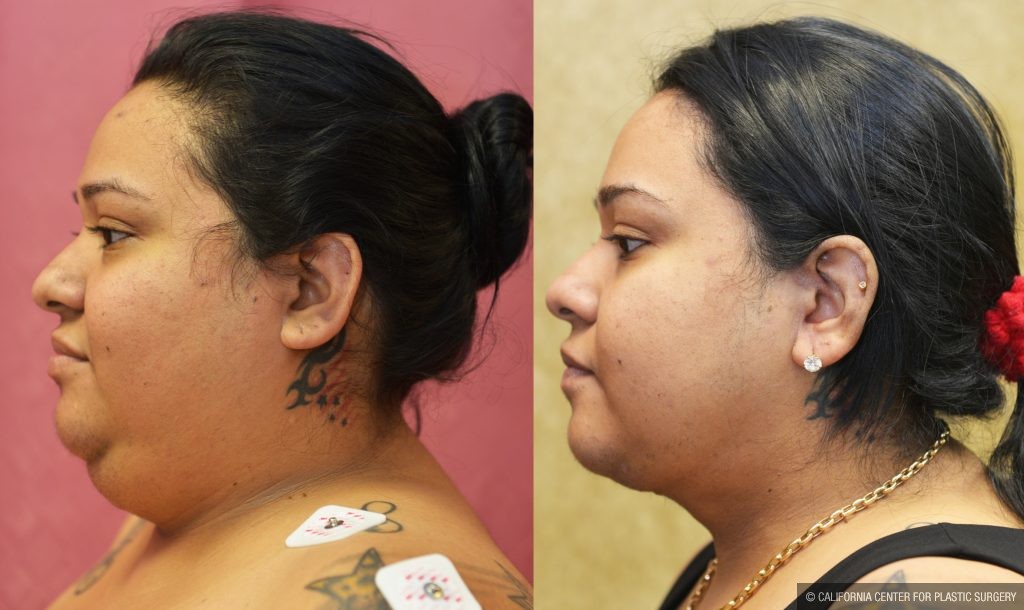 Neck & Face Liposuction Before & After Patient #12512