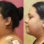 Neck & Face Liposuction Before & After Patient #12512