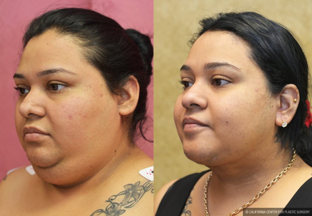 Neck & Face Liposuction Before & After Patient #12512