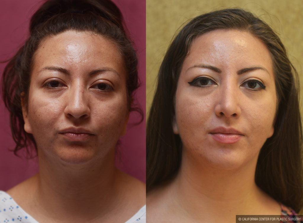 Hispanic Rhinoplasty Before & After Patient #11020