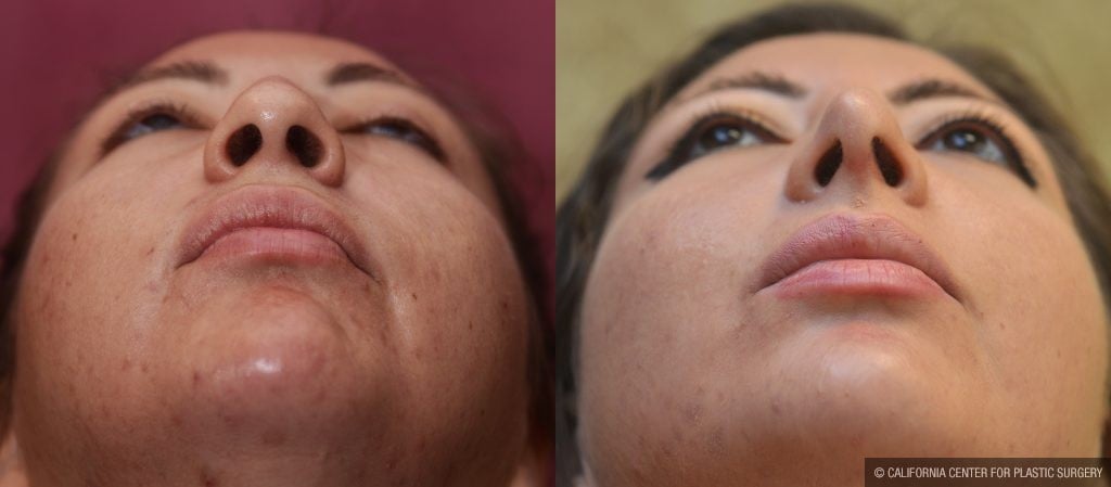 Rhinoplasty - Hispanic Before & After Patient #11020