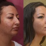 Rhinoplasty - Hispanic Before & After Patient #11020