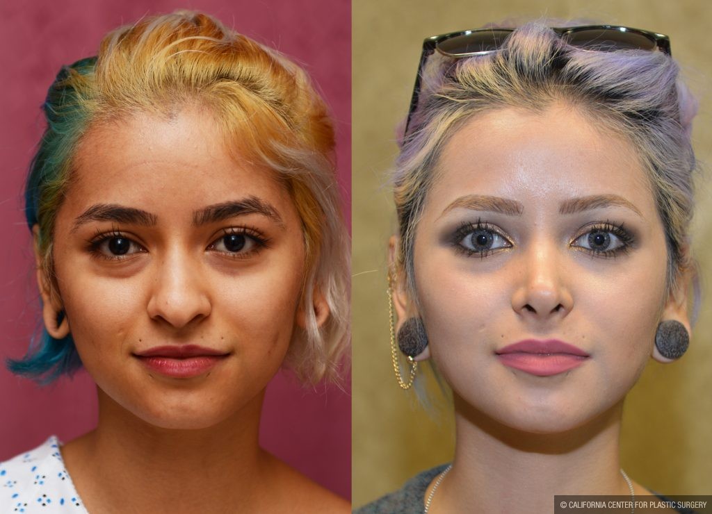 Rhinoplasty - Hispanic Before & After Patient #11013