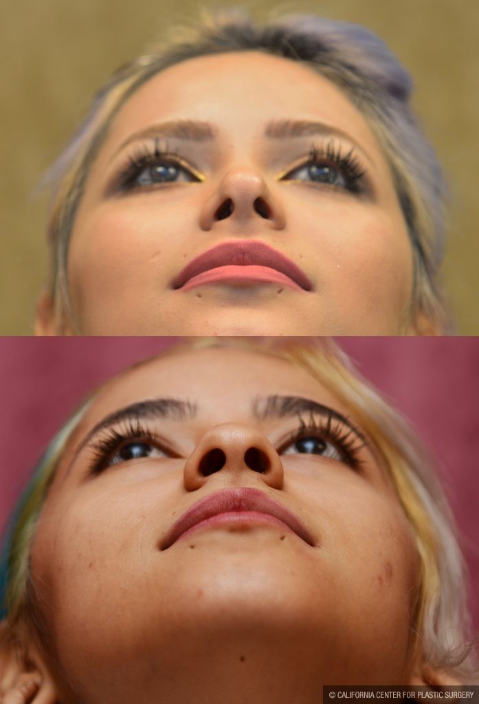 Rhinoplasty - Hispanic Before & After Patient #11013