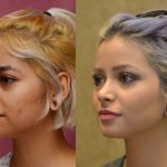 Rhinoplasty - Hispanic Before & After Patient #11013