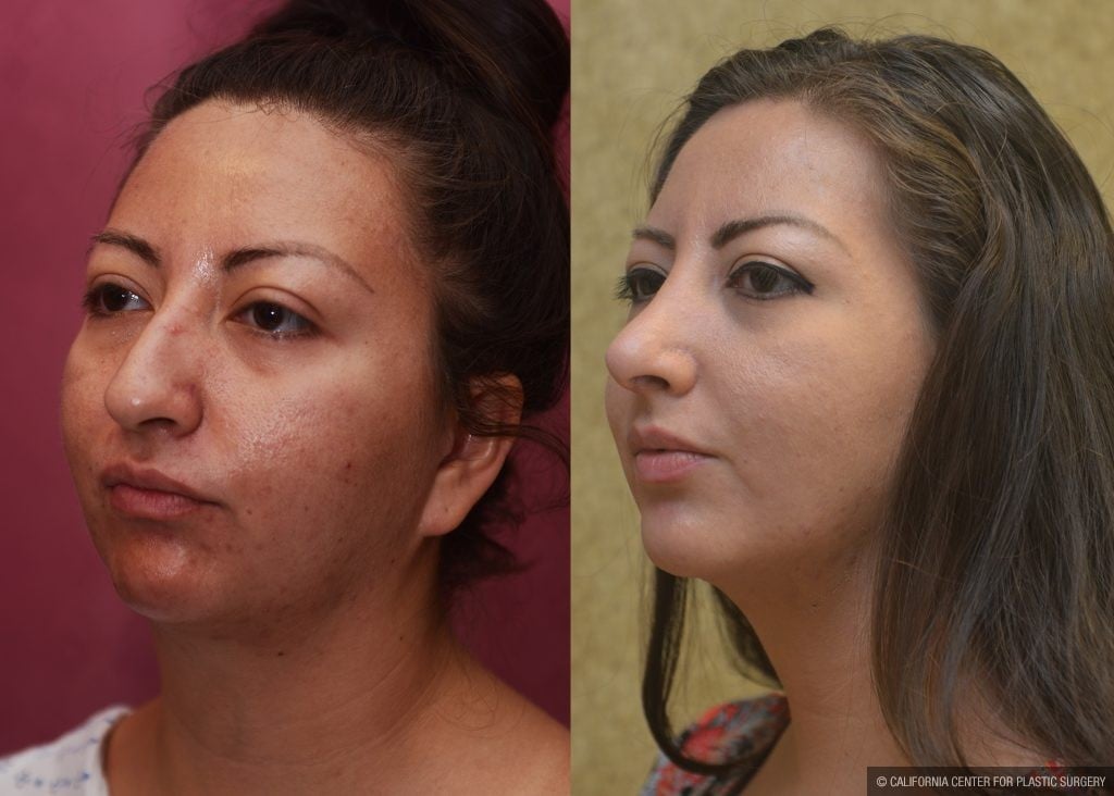 Rhinoplasty - Hispanic Before & After Patient #11020