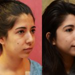 Rhinoplasty - Hispanic Before & After Patient #11026