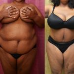 Tummy Tuck (Abdominoplasty) Plus Size Before & After Patient #11037