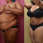 Tummy Tuck (Abdominoplasty) Plus Size Before & After Patient #11037
