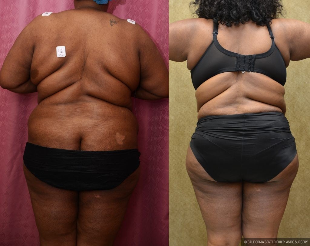 Patient #5874 Tummy Tuck (Abdominoplasty) Plus Size Before and