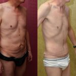 Tummy Tuck (Abdominoplasty) Small Size Before & After Patient #11075