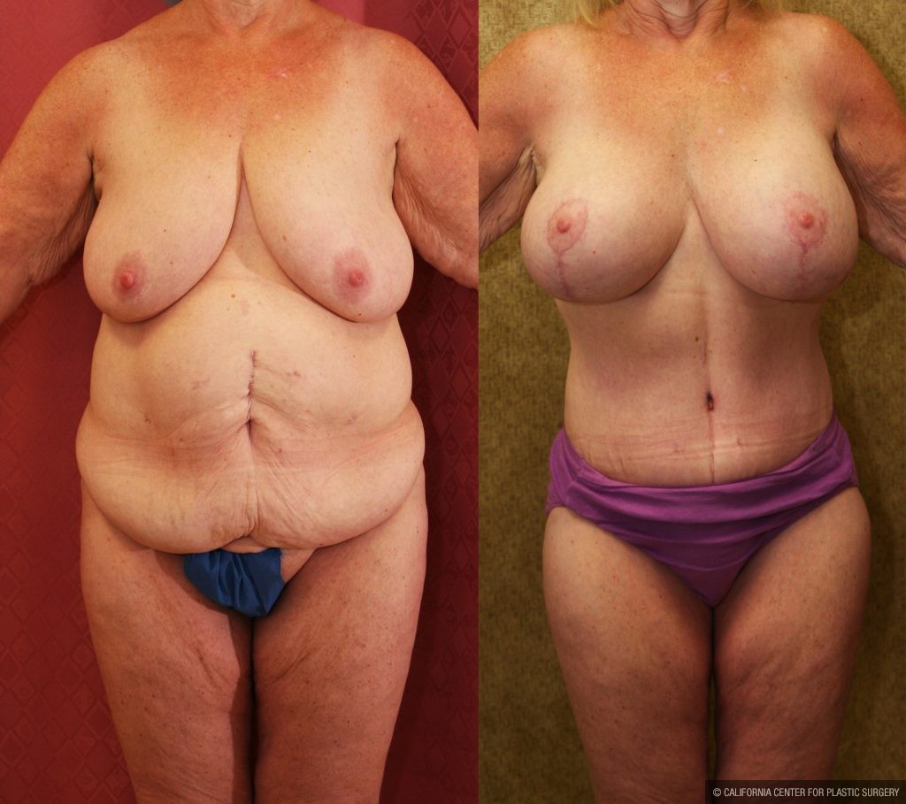 Tummy Tuck (Abdominoplasty) Medium Size Before & After Patient #11083