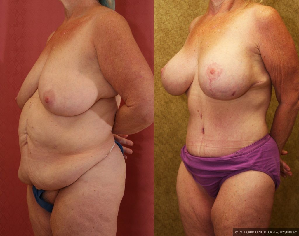 Tummy Tuck (Abdominoplasty) Medium Size Before & After Patient #11083