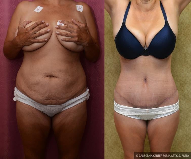 Tummy Tuck Scars Before & After Patient #11111