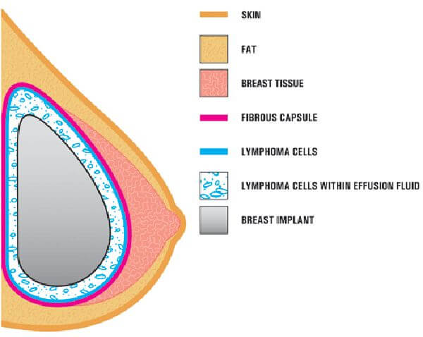 breast implant recall diagram
