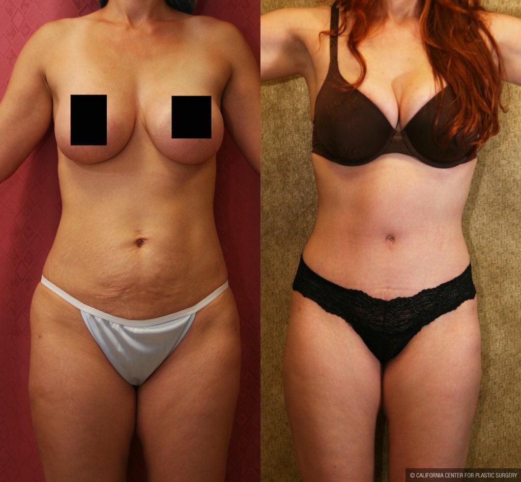 Breast Lift (Mastopexy) Before & After Patient #11434