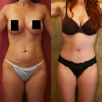 Breast Lift (Mastopexy) Before & After Patient #11434