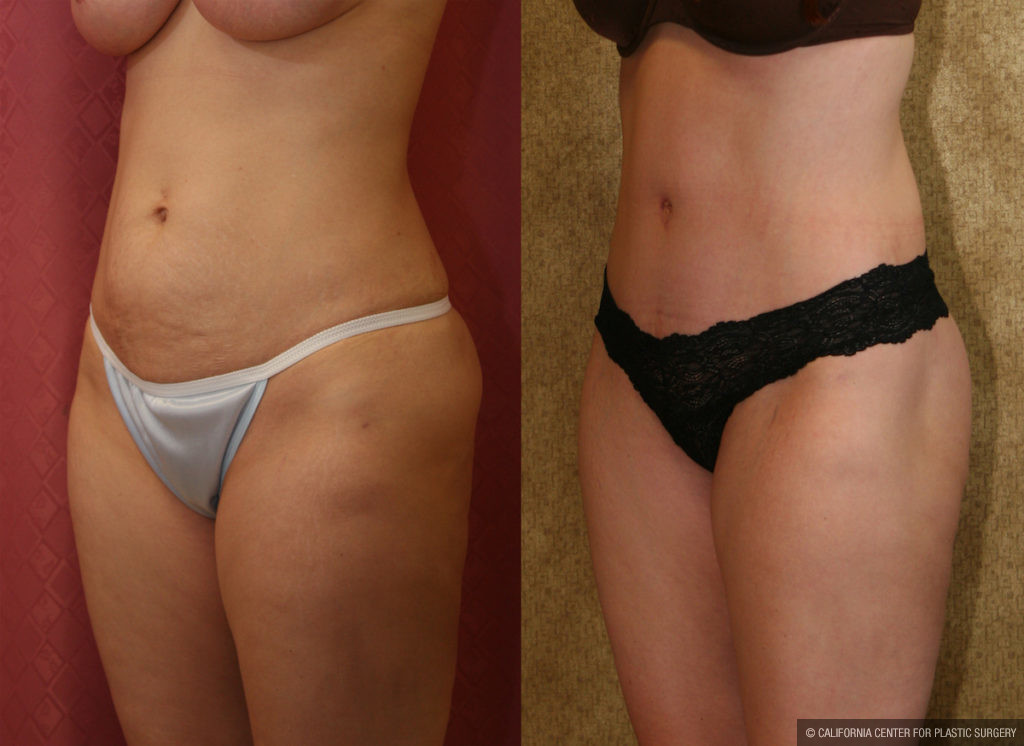 Breast Lift (Mastopexy) Before & After Patient #11434