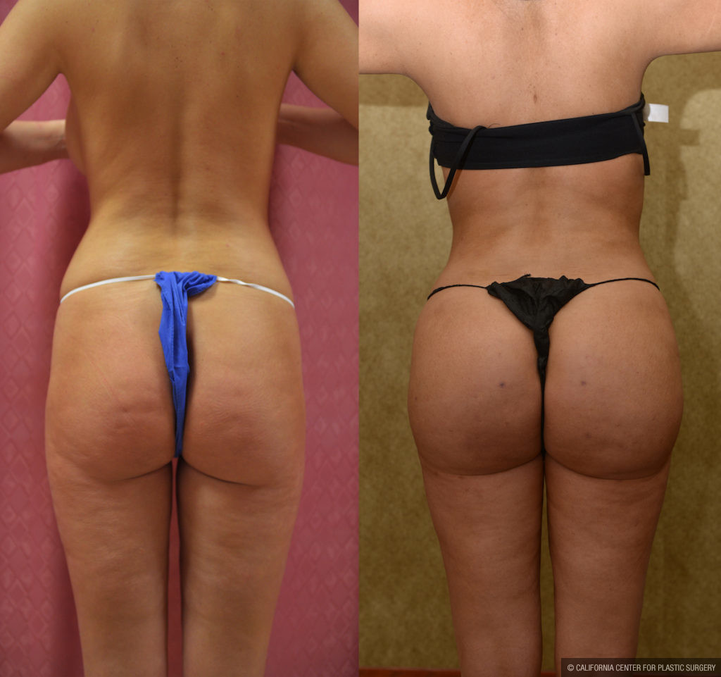 Buttock Lift/Augmentation Before & After Patient #11439