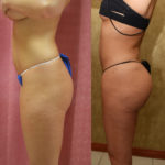 Buttock Lift/Augmentation Before & After Patient #11439