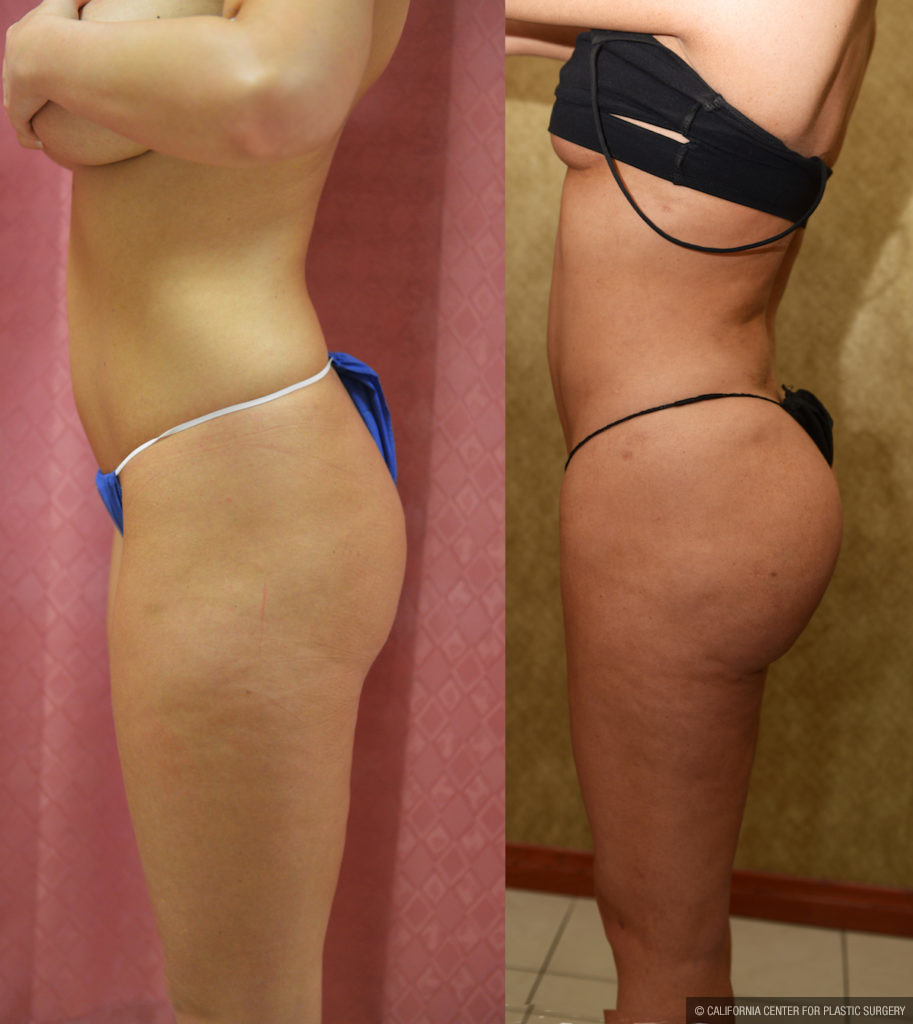 Buttock Lift/Augmentation Before & After Patient #11439