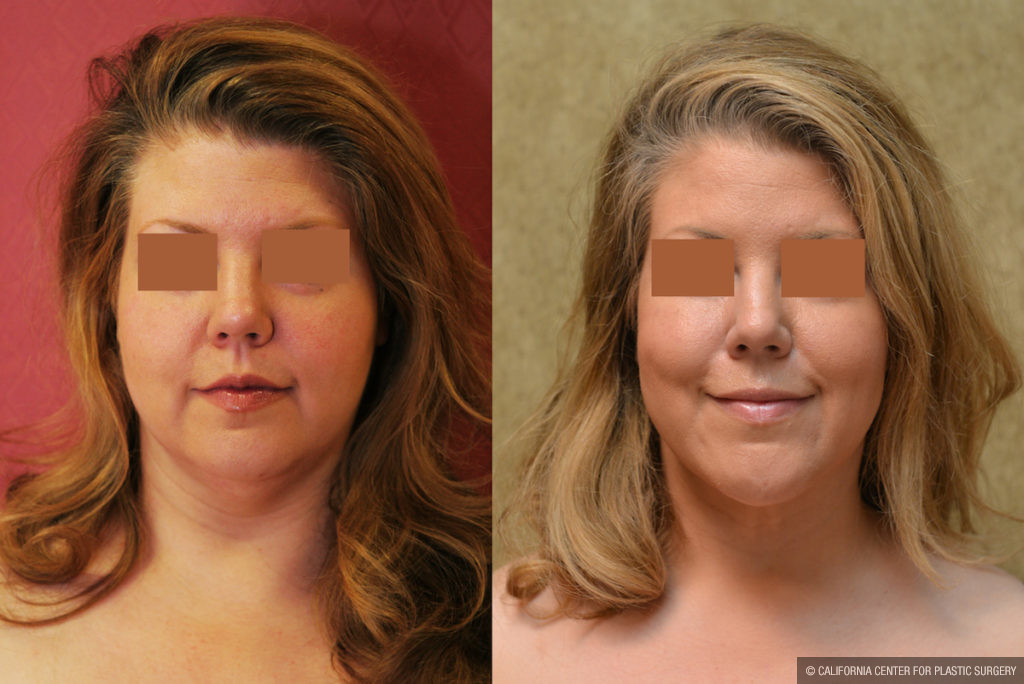 Neck & Face Liposuction Before & After Patient #11501