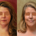 Neck & Face Liposuction Before & After Patient #11501