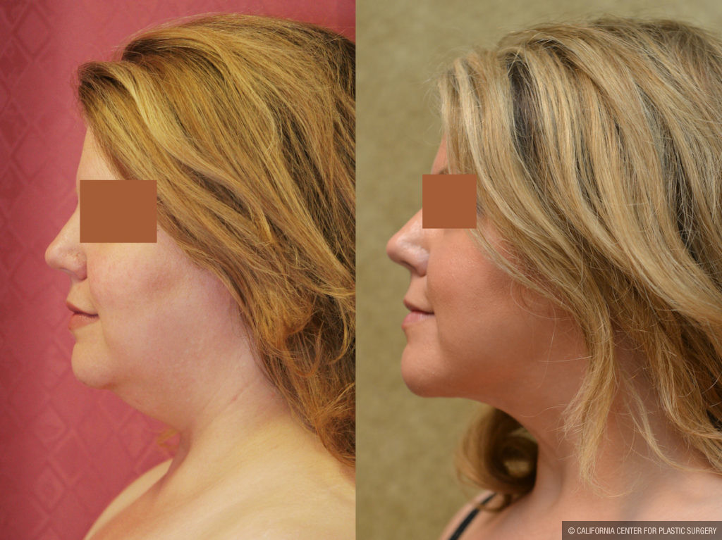 Neck & Face Liposuction Before & After Patient #11501