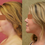 Neck & Face Liposuction Before & After Patient #11501