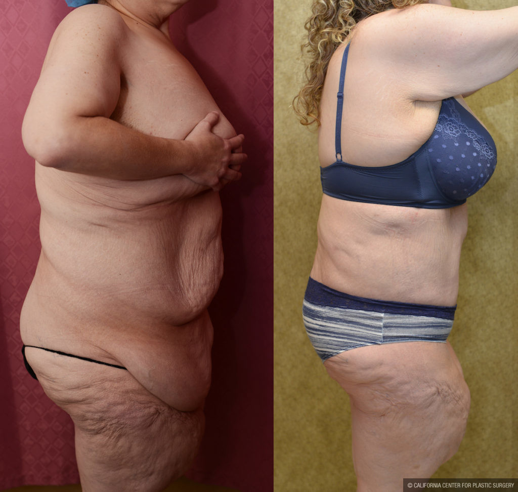 Tummy Tuck (Abdominoplasty) Plus Size Before & After Patient #11557