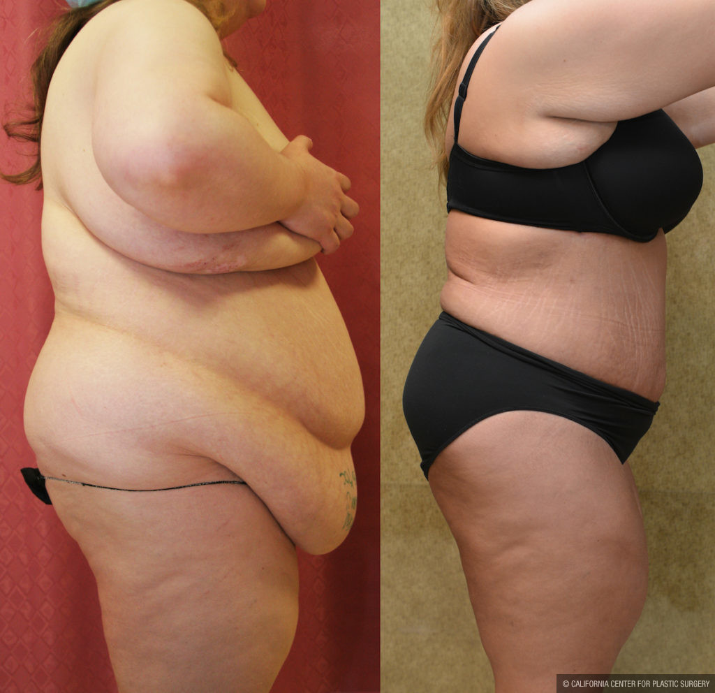 Tummy Tuck (Abdominoplasty) Plus Size Before & After Patient #11561