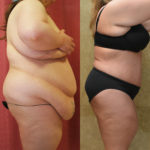 Tummy Tuck (Abdominoplasty) Plus Size Before & After Patient #11561