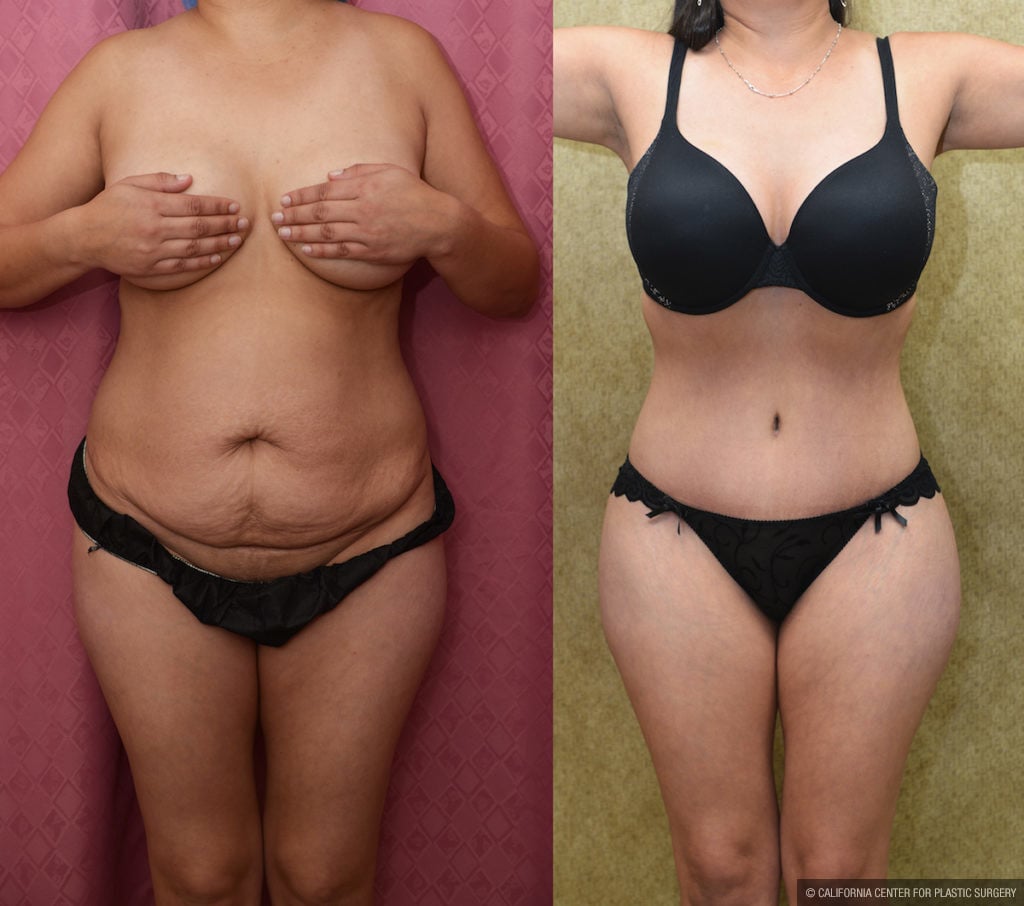 Tummy Tuck (Abdominoplasty) Medium Size Before & After Patient #11523