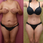 Tummy Tuck (Abdominoplasty) Medium Size Before & After Patient #11523