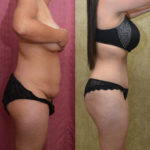 Tummy Tuck (Abdominoplasty) Medium Size Before & After Patient #11523