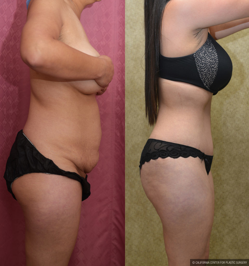 Tummy Tuck (Abdominoplasty) Medium Size Before & After Patient #11523