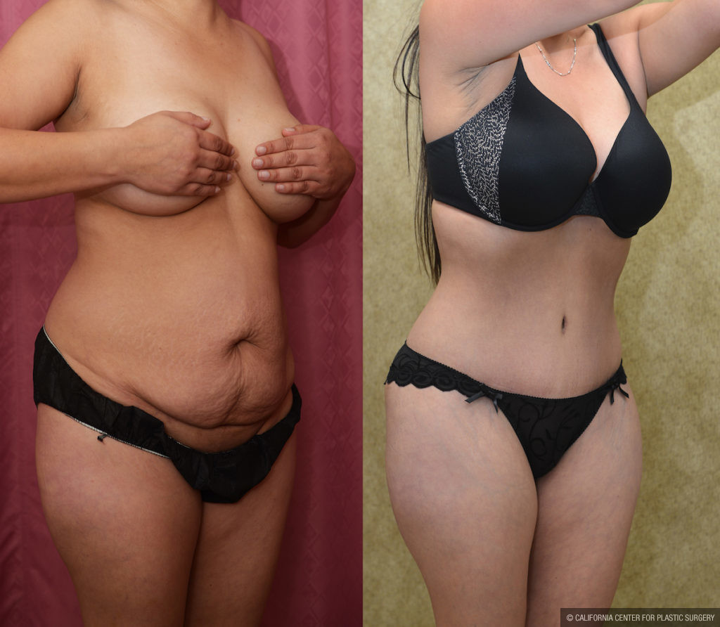 Tummy Tuck (Abdominoplasty) Medium Size Before & After Patient #11523