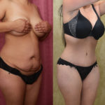 Tummy Tuck (Abdominoplasty) Medium Size Before & After Patient #11523