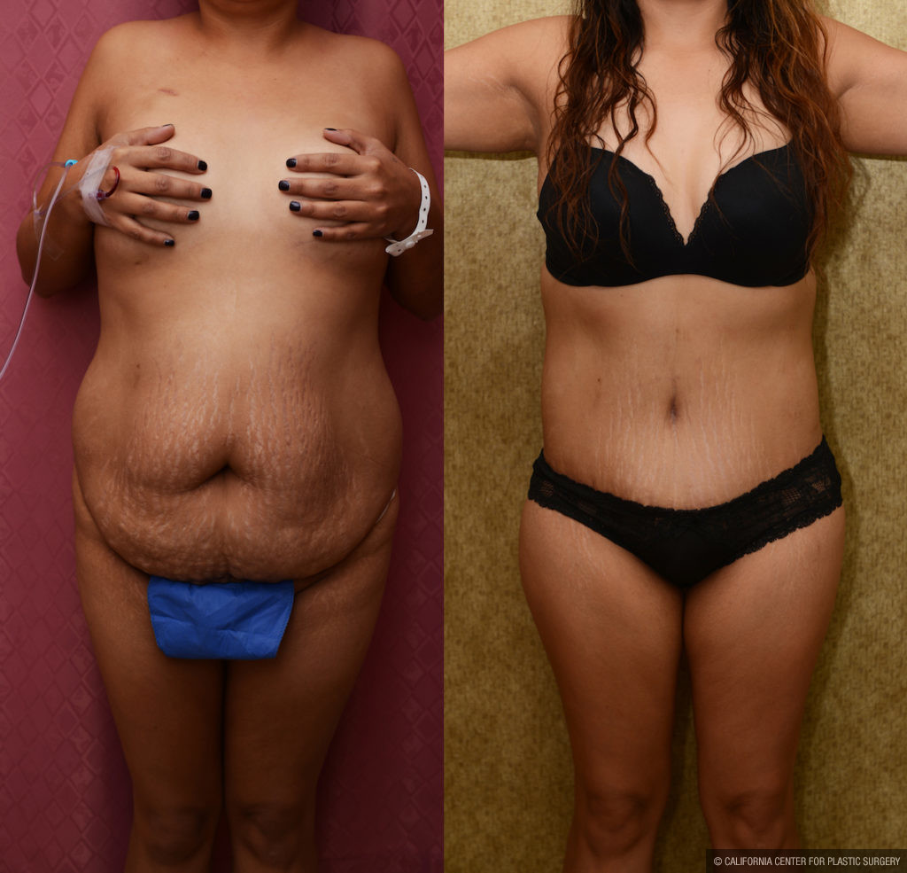 Tummy Tuck (Abdominoplasty) Medium Size Before & After Patient #11530