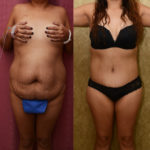 Tummy Tuck (Abdominoplasty) Medium Size Before & After Patient #11530