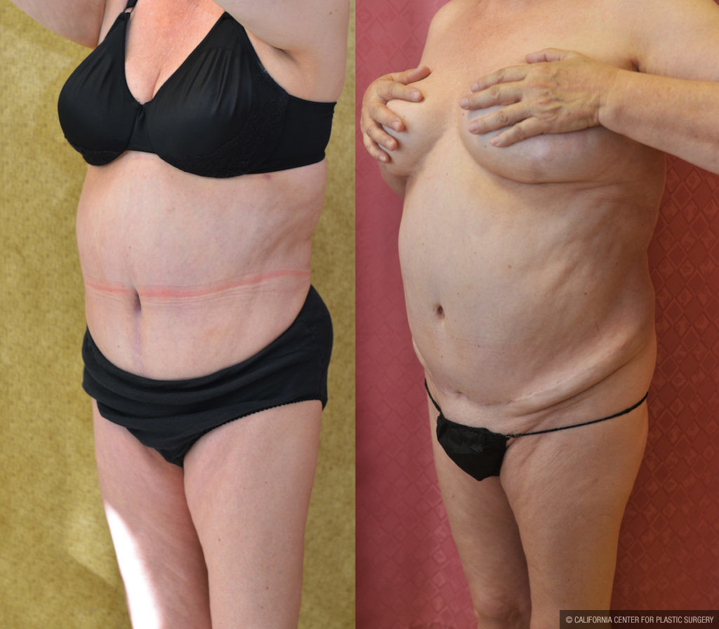 Tummy Tuck Medium Size Before & After Patient #11527