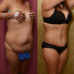 Tummy Tuck (Abdominoplasty) Medium Size Before & After Patient #11530