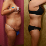 Tummy Tuck (Abdominoplasty) Medium Size Before & After Patient #11530