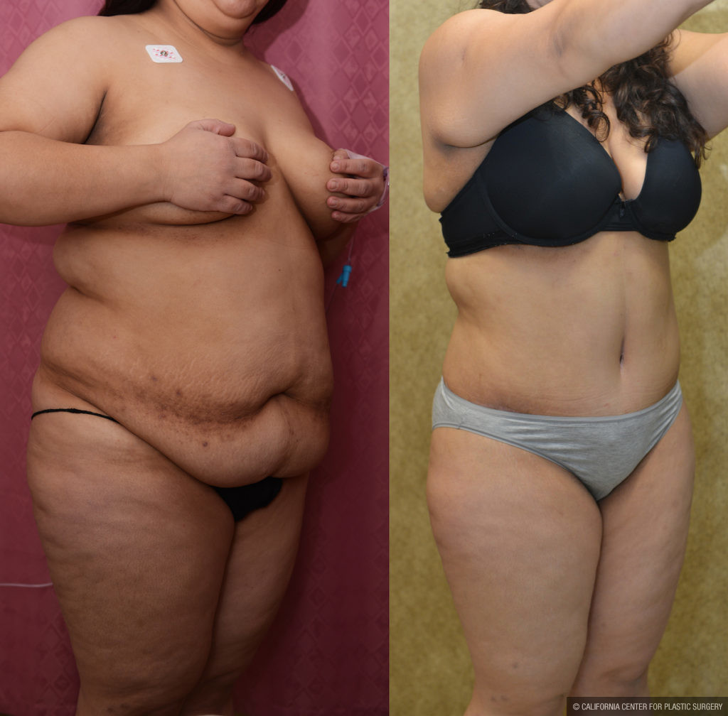 Tummy Tuck (Abdominoplasty) Plus Size Before & After Patient #11534