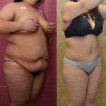 Tummy Tuck (Abdominoplasty) Plus Size Before & After Patient #11534