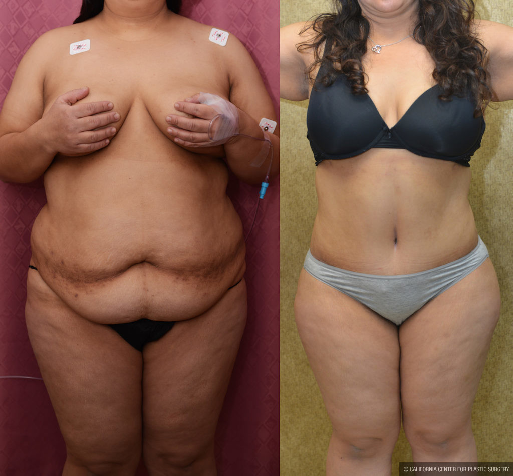 Tummy Tuck (Abdominoplasty) Plus Size Before & After Patient #11534