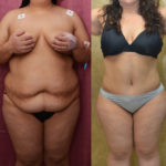 Tummy Tuck (Abdominoplasty) Plus Size Before & After Patient #11534