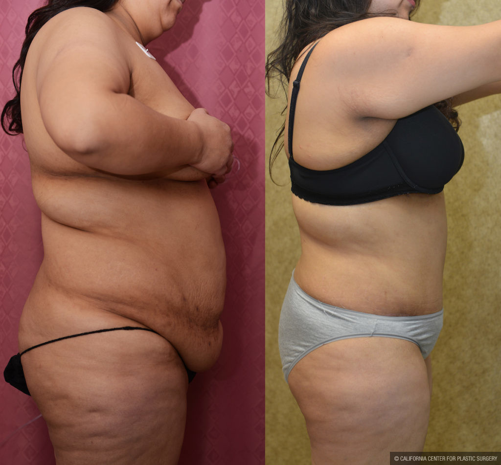 Tummy Tuck (Abdominoplasty) Plus Size Before & After Patient #11534