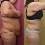 Tummy Tuck (Abdominoplasty) Plus Size Before & After Patient #11534